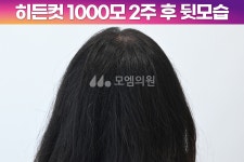 후기 (모엠의원/정수리/전지훈원장) - 정수리 - 모엠의원 여성 후기-히든컷, 헤어라인교정... 1000모 1년 후기 (모엠의원/정수리/전지훈원장)