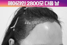 헤어라인 - 모엠의원 여성 후기-히든컷, 헤어라인교정, 탈모치료, 재수술 [30대 여자 넓은 M자 이마 헤어라인 모발이식] 비절개 히든컷 2800모... 