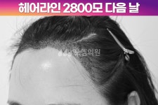 헤어라인 - 모엠의원 여성 후기-히든컷, 헤어라인교정, 탈모치료, 재수술 [30대 여자 넓은 M자 이마 헤어라인 모발이식] 비절개 히든컷 2800모... 