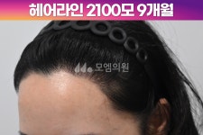 후기 (모엠의원/헤어라인/전지훈원장) - 헤어라인 - 모엠의원 여성 후기-히든컷... 2100모 1년1개월 후기 (모엠의원/헤어라인/전지훈원장)