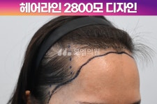 [20대 여자 M자 헤어라인 비절개 모발이식] 히든컷 2800모 1년 후기 (모엠의원/헤어라인/전지훈원장) - 헤어라인 - 모엠의원 여성 후기-히든컷... 