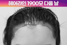 [30대 여자 M자이마 헤어라인 교정수술] 비절개 히든컷 모발이식 1900모 1년 후기 (모엠의원/헤어라인/전지훈원장) - 헤어라인 - 모엠의원 여성... 