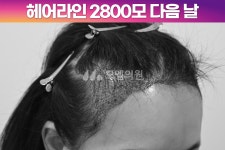 후기 (모엠의원/헤어라인/전지훈원장) - 헤어라인 - 모엠의원 여성 후기-히든컷... 모발이식 2800모 1년 후기 (모엠의원/헤어라인/전지훈원장)