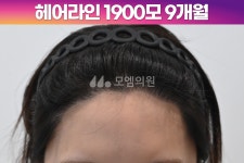 헤어라인 - 모엠의원 여성 후기-히든컷, 헤어라인교정, 탈모치료, 재수술 [20대 여자 비대칭 M자 헤어라인 교정수술] 비절개 히든컷 모발이식... 