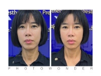 얼굴윤곽술은 Jh윤곽술로 이뻐지기 - 마사지-본힐링테라피 - 대구 & 경북맘 (대경맘) 얼굴윤곽술은 Jh윤곽술로 이뻐지기
