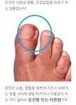 엄지 발가락이 부어서 아프다면 발톱을 일자로 자르세요 - 웃긴자료... - 도탁스 (DOTAX) 엄지 발가락이 부어서 아프다면 발톱을 일자로 자르세요