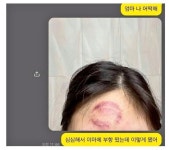 심심해서 이마에 부항 떠 본 여자 - 웃긴자료 ‥‥‥‥‥、 - 도탁스 (DOTAX) 심심해서 이마에 부항 떠 본 여자