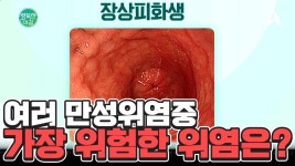 여러 만성위염중 가장 위험한 위염은? | ZUM TV