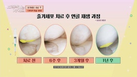 3~6주면 일상생활 OK! 줄기세포 연골 재생 치료 효과 | JTBC 220918 방송 | ZUM TV