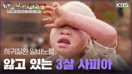 희귀질환 알비노를 앓고 있는 3살 사피아 | KBS 250420 방송 | ZUM TV 희귀질환 알비노를 앓고 있는 3살 사피아  | KBS 250420 방송 | ZUM TV