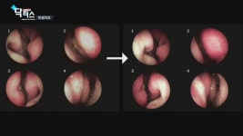 메디컬24시닥터스(171028) 면역체계를 다스리고 코 건강을 지켜라 1부 (장복선 코호한의원 창원점 원장) | ZUM TV