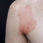 15,199 Dermatitis Stock Photos - Free & Royalty-Free Stock Photos from Dreamstime