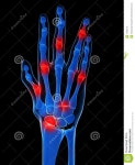 Athritis Royalty Free Stock Image - Image: 11962176 Athritis