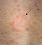 Pityriasis rosea