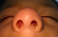 Nasal septal hematoma