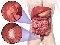 Colorectal cancer