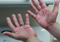 Chemotherapy-induced acral erythema