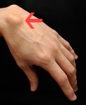 Ganglion cyst