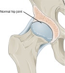Osteoarthritis