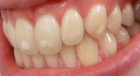 Dental fluorosis