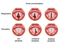Vocal cord paresis
