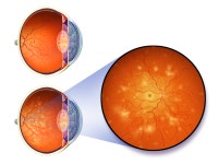 Diabetic retinopathy