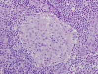 Granuloma