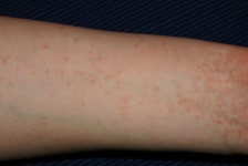 Scabies