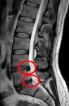 Disc herniation