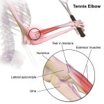 Tennis elbow