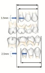 Occlusion (dentistry)