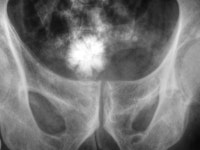 Bladder stone