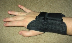Carpal tunnel syndrome
