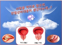 웹진 인벤 : 사정을 억지로 참으면 전립선비대증에 걸리는게 사실인가요?? - 오픈이슈갤러리 사정을 억지로 참으면 전립선비대증에 걸리는게... 