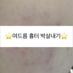 ⭐️⭐️(kimgh8627)님의 스타일       | 6개월동안 여드름흉터 때문에 진짜 스트레스 받았는데 한달만에 극복했다!!!!!아직 남아있긴 하지만... 