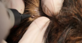 동물병원에서 액체질소로 피부의 신생물을 치료하고 있습니다.... 냉동파괴술(Cryodestruction)은 피부과적 병리를 치료하는 통증 없는... 