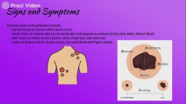 Visual Presentation - Skin Cancer 제작 Praveena Sathyarajah on Prezi Video Visual Presentation - Skin Cancer