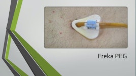 Percutaneous Endoscopic Gastrostomy (PEG) Training 제작... on Prezi Video Percutaneous Endoscopic Gastrostomy (PEG) Training