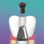 이노덴 더이상 시멘트로 고민하지 마세요 - 덴탈아리랑 이노덴 더이상 시멘트로 고민하지 마세요