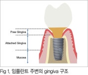 [임상특강] 송일석 원장의 수술 노하우 - Advanced Implant Surgery 8 - 덴탈아리랑 [임상특강] 송일석 원장의 수술 노하우... 
