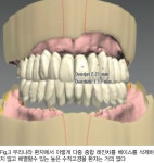 [임상특강] 의치 베이스만 밀링으로 제작하자 - 덴탈아리랑 [임상특강] 의치 베이스만 밀링으로 제작하자