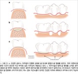 [임상특강] POAAT 미래치과 임상 26. Periodontal Osseous Surgery(I) - 덴탈아리랑 [임상특강] POAAT 미래치과 임상 26.... 