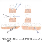 [임상특강] POAAT 미래치과 임상 27. Periodontal Osseous Surgery(II) - 덴탈아리랑 [임상특강] POAAT 미래치과 임상 27.... 