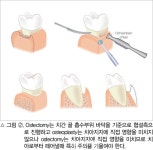 [임상특강] POAAT 미래치과 임상 27. Periodontal Osseous Surgery(II) - 덴탈아리랑 [임상특강] POAAT 미래치과 임상 27.... 