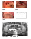 임플란트 대가가 진단하는 성공적인 치료법 비결은 ‘평생 결혼’ 처럼 - 덴탈아리랑 임플란트 대가가 진단하는 성공적인 치료법 비결은 ‘평생... 