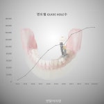 디오 ‘디오나비’, 누적 식립 100만 홀 고지 눈앞 - 덴탈아리랑 디오 ‘디오나비’, 누적 식립 100만 홀 고지 눈앞