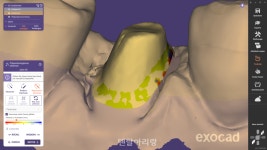 exocad가 선보이는 새로운 마진 수정 기능 소개 - 덴탈아리랑 exocad가 선보이는 새로운 마진 수정 기능 소개
