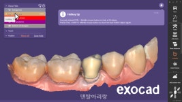 exocad가 선보이는 새로운 마진 수정 기능 소개 - 덴탈아리랑 exocad가 선보이는 새로운 마진 수정 기능 소개
