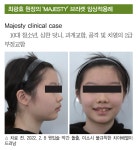 고려한 교정치료 - 덴탈아리랑 최광효 원장의 덧니와 과개교합이 심한 청소년 환자의 안모를 고려한 교정치료