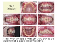 최광효 원장의 덧니와 과개교합이 심한 청소년 환자의 안모를 고려한 교정치료 - 덴탈아리랑 최광효 원장의 덧니와 과개교합이 심한 청소년... 